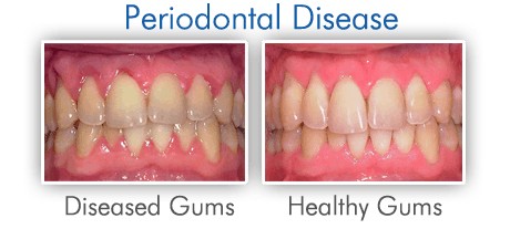 Periodontal Disease: Causes, Symptoms, and Treatment